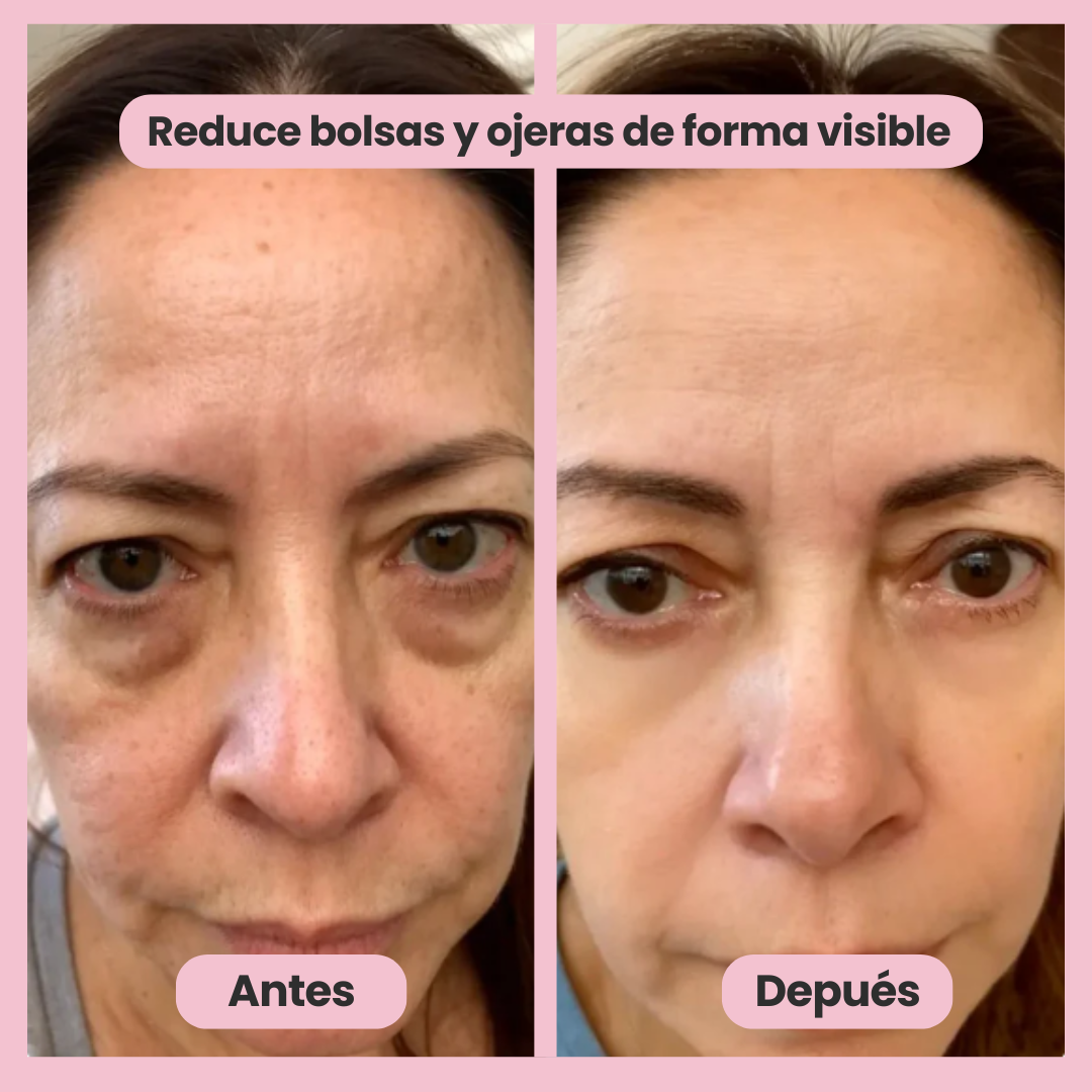 Adiós bolsas & ojeras. Más luz en tu mirada.